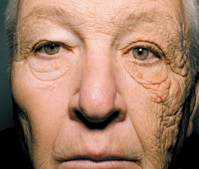 Motoristas caminhoneiros são muito propensos ao fotoenvelhecimento